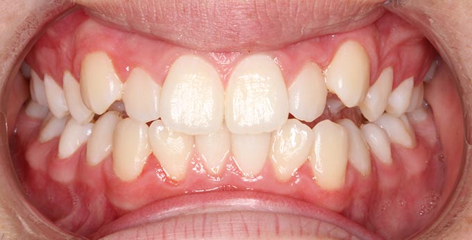 Crowded and misaligned teeth, with anterior crossbites before Orthodontic treatment